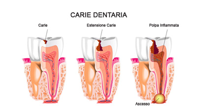 denti cariati